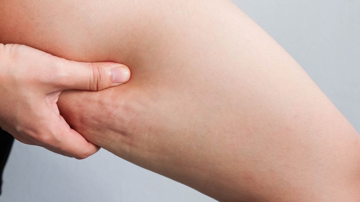 Celulitis