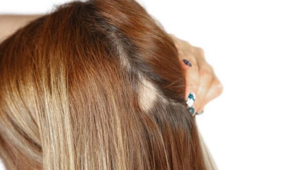 alopecia por tracci&oacute;n