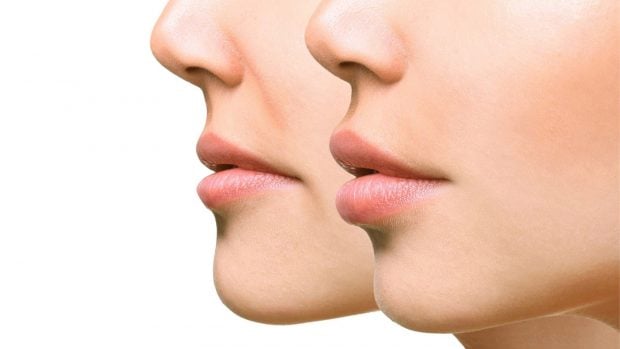 Gracias a un tratamiento de l&aacute;ser se pueden eliminar las arrugas del labio superior./Arques Clinic