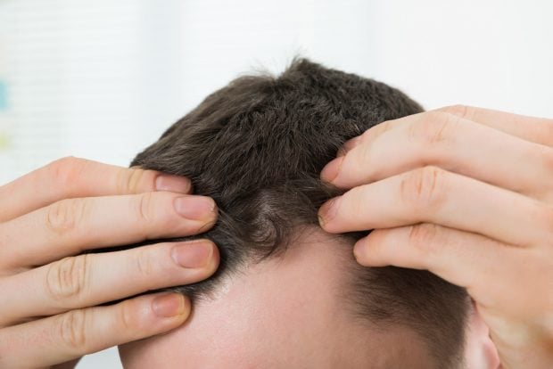 alopecia 