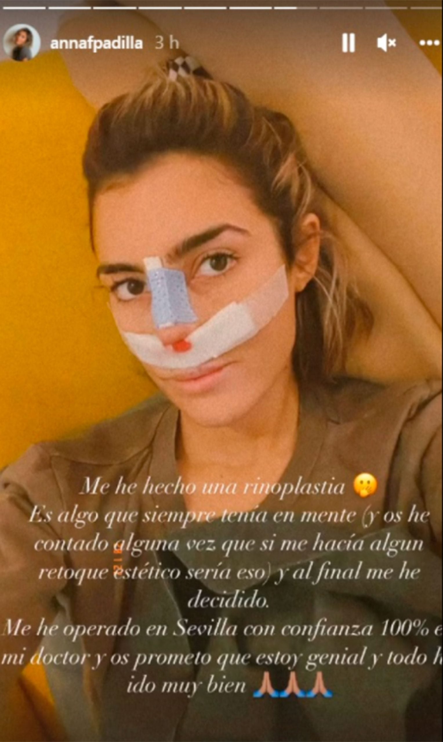 Anna Ferrer se ha sometido a una rinoplastia. / Instagram