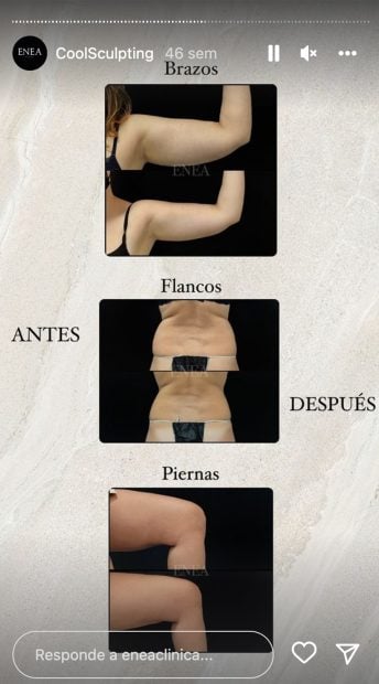 Coolsculpting / Instagram
