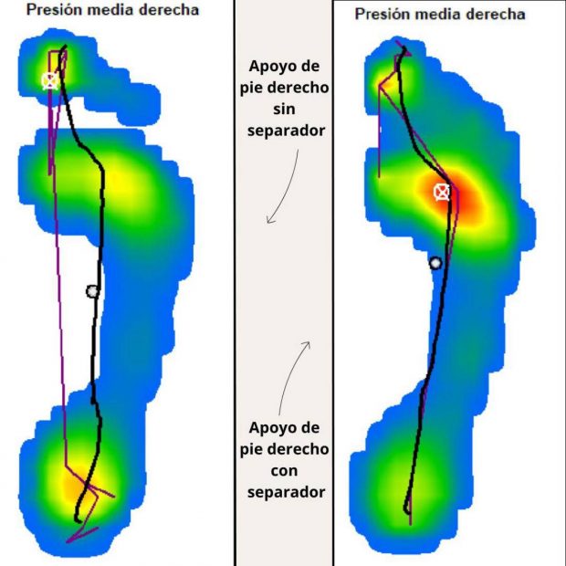 Imagen baropodom&eacute;trica donde observamos que el pie que lleva separador genera una sobrecarga a nivel metatarsal.