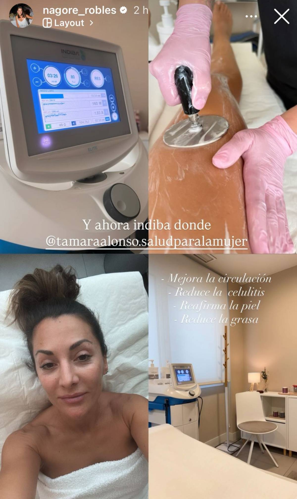 Nagore Robles disfruta de una sesi&oacute;n de Indiba corporal. (Foto: Redes Sociales)