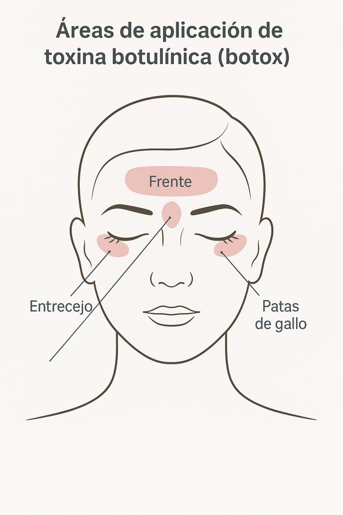 Zonas del rostro donde se aplica la toxina botulínica. (Foto: IA)