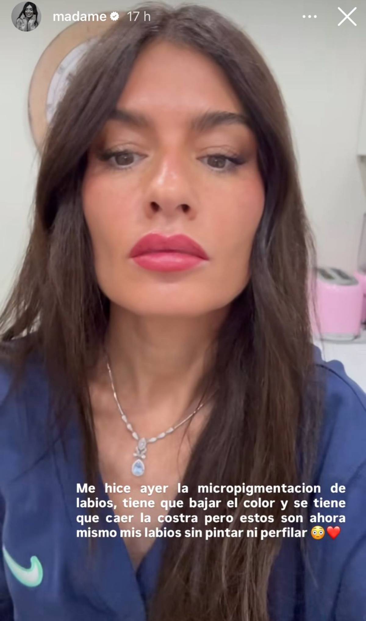 Madame de Rosa muestra el resultado inmediato de su micropigmentaci&oacute;n de labios. (Foto: Redes Sociales)