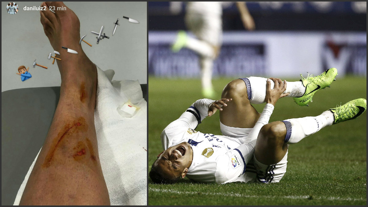 Así quedó la pierna de Danilo tras su lesión en Pamplona.