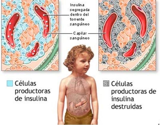 Investigan alimentos recomendados para prevenir la diabetes tipo 1