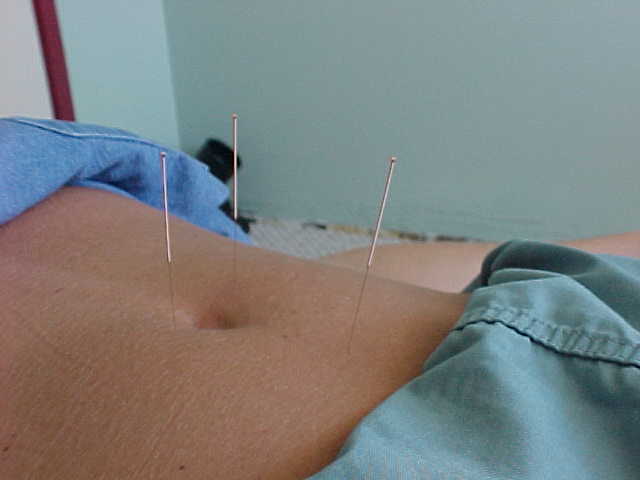 Sirve la acupuntura para adelgazar?