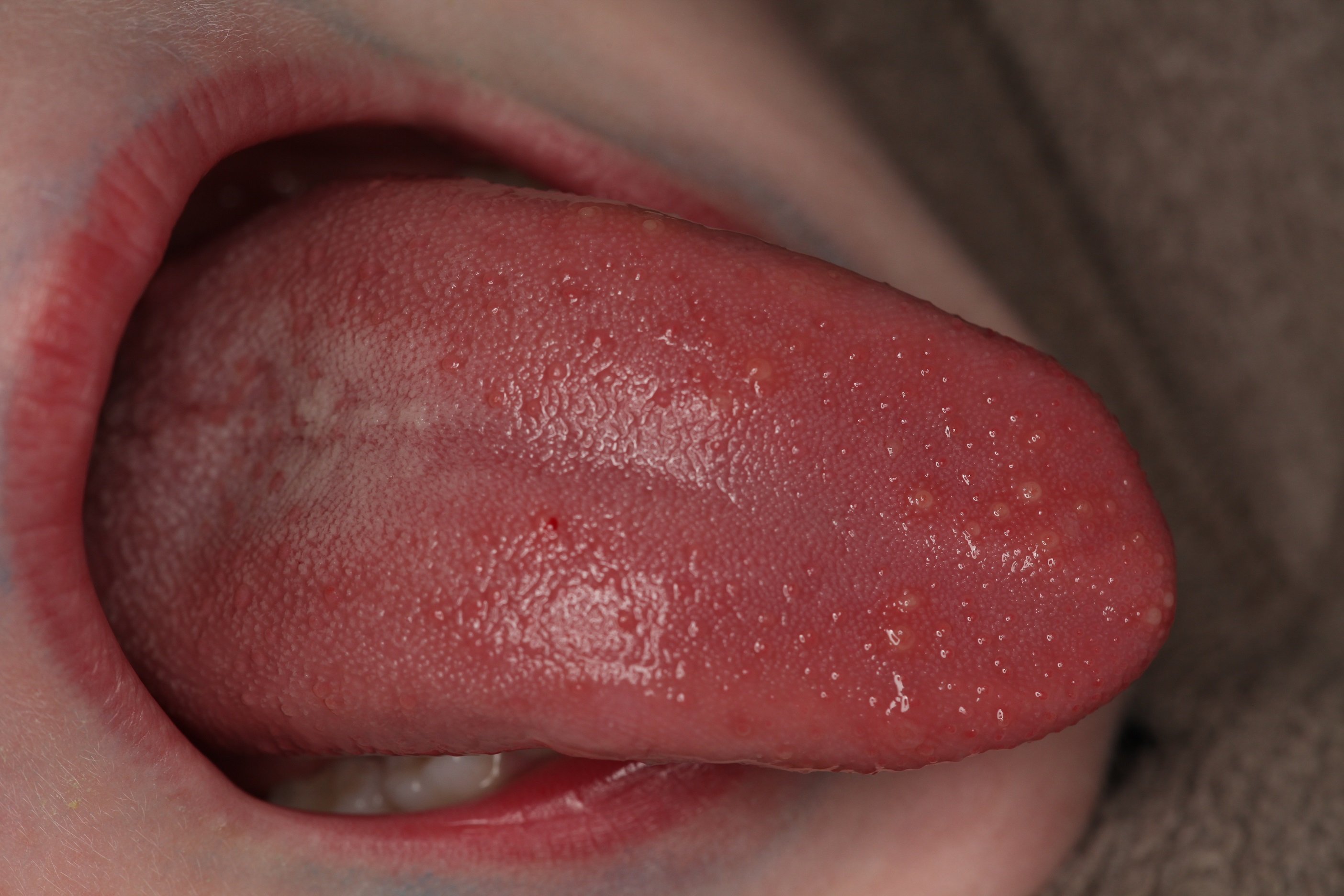 ¿Por qué salen llagas en la lengua?