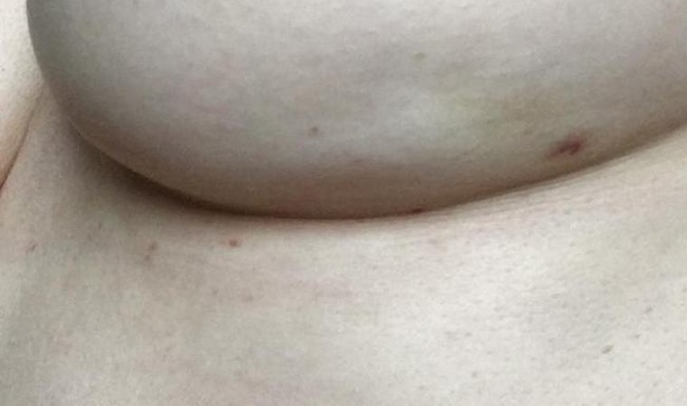 Los síntomas del cáncer de mama aparecen en una foto que se ha convertido en viral