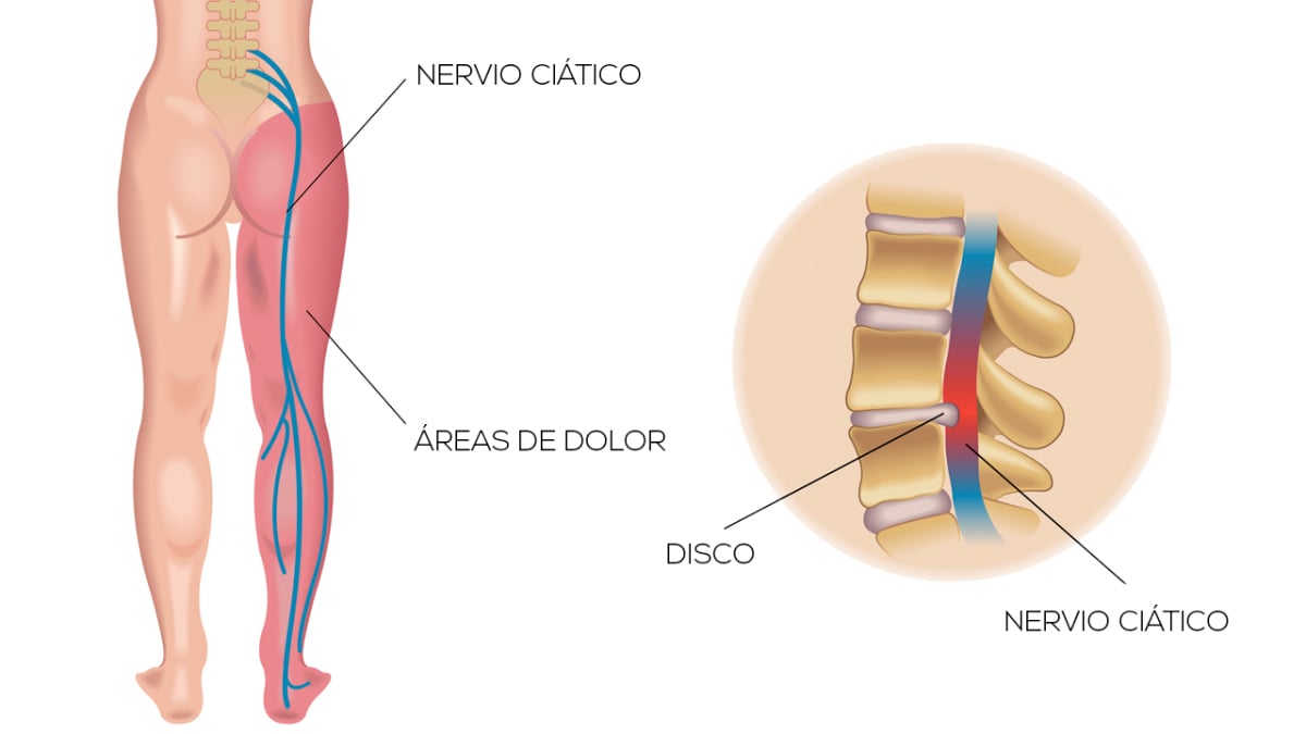 Ciática: lesiones