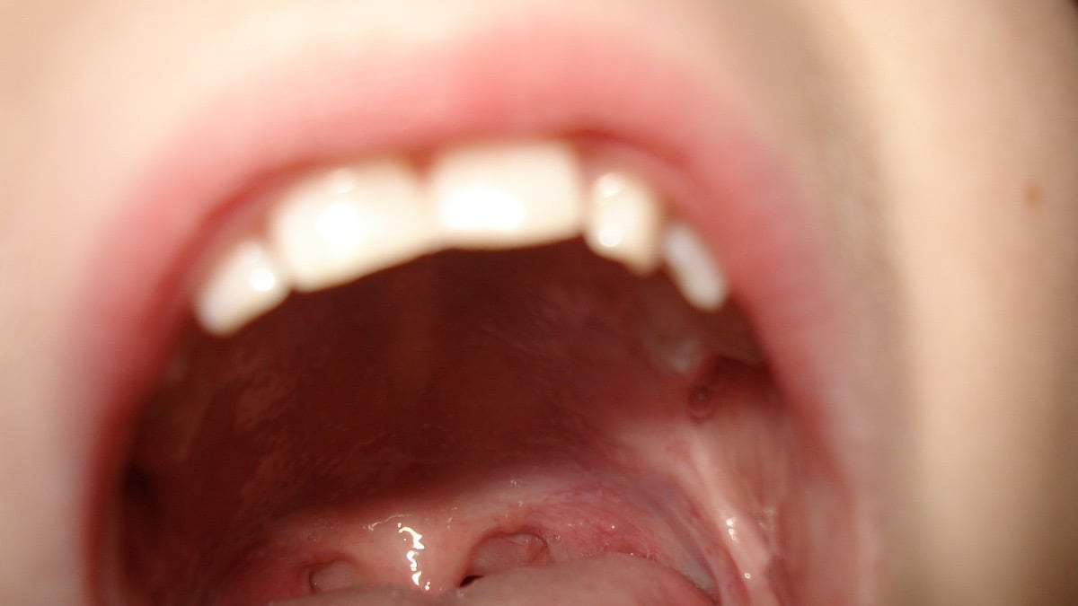 cáncer de lengua 