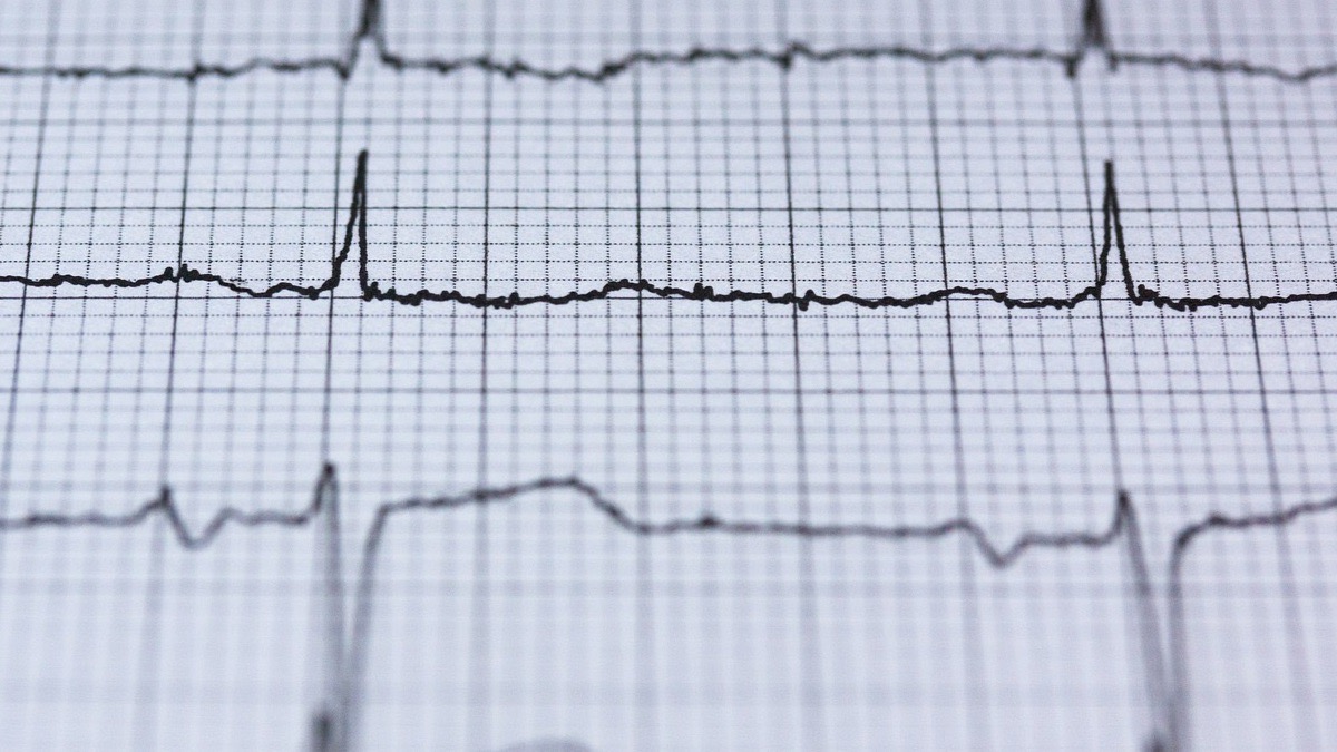 ¿qué Es Un Electrocardiograma Para Qué Sirve Y Cómo Se Realizaemk 7783