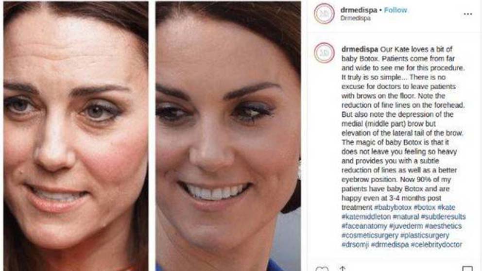 ¿Se ha puesto botox Kate Middleton? La polémica que sacude a Reino Unido