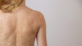 El acné es un problema de la piel que afecta a millones de personas