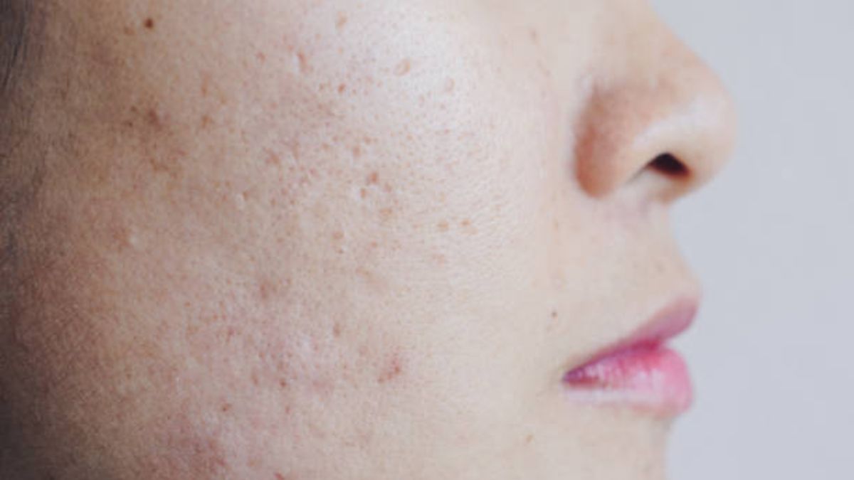 Tips y poder reducir poros dilatados