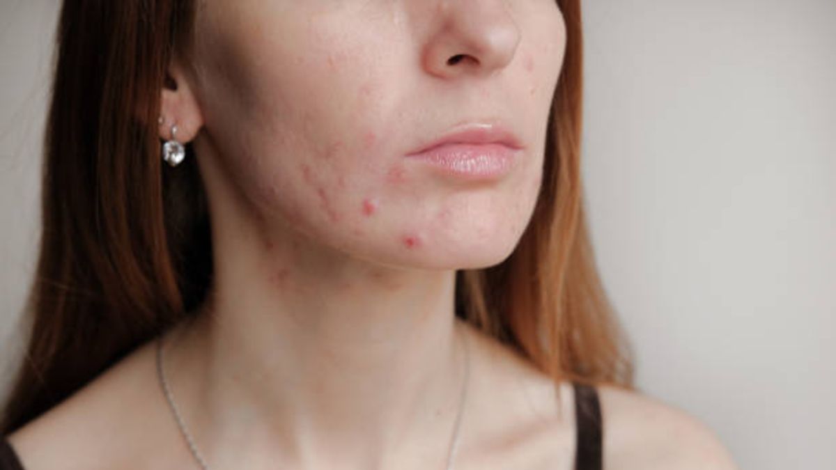 mecanógrafo necesidad Tubería Tips y remedios para deshacerse de los granos de la cara | Belleza