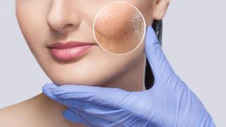 Descubre de qué manera puedes eliminar las cicatrices del acné con láser