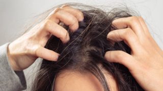 Qué es y cómo tratar el acné del cuero cabelludo