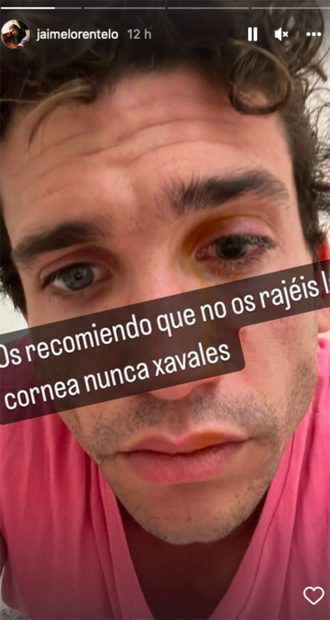 Jaime Lorente sufre una lesión en la córnea / Instagram @jaimelorentelo
