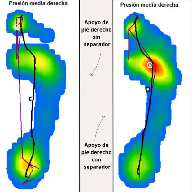 Imagen baropodométrica donde observamos que el pie que lleva separador genera una sobrecarga a nivel metatarsal.