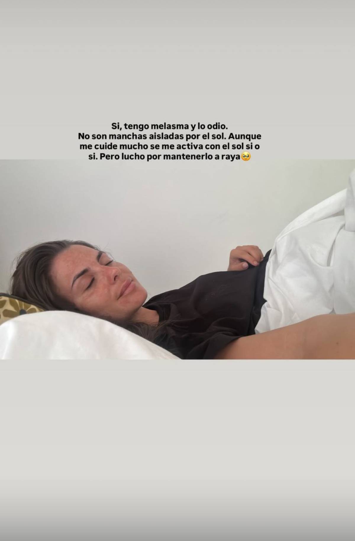  Imagen de Alexia tumbada en la cama, donde reconoce tener melasma. (Redes Sociales)