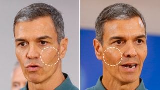 Efecto del posible relleno de ácido hialurónico.