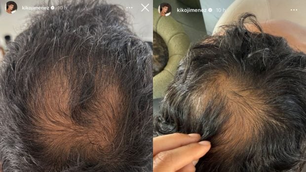 Las calvas que Kiko Jiménez ha mostrado en Intagram. (Fotos: Redes sociales)