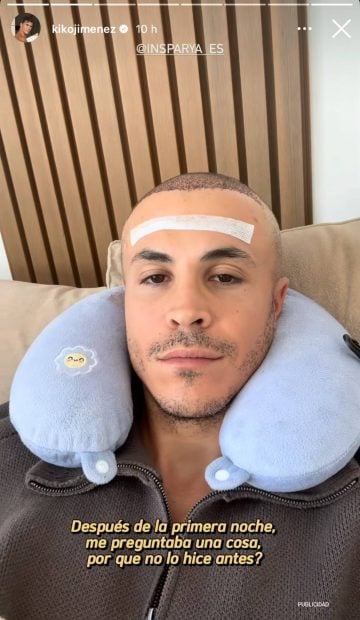 Kiko Jiménez en plena recuperación tras su injerto capilar. (Foto: Redes sociales)