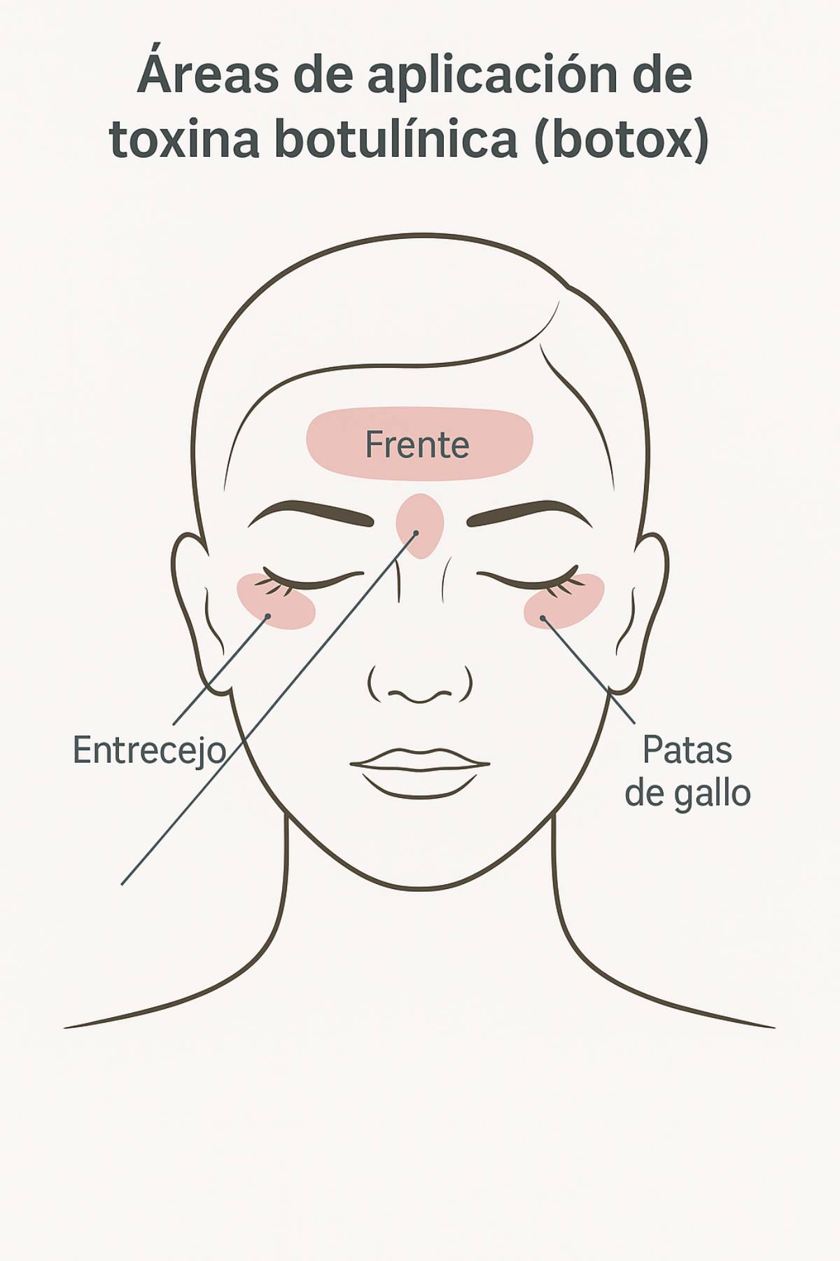 Zonas del rostro donde se aplica la toxina botulínica. (Foto: IA)