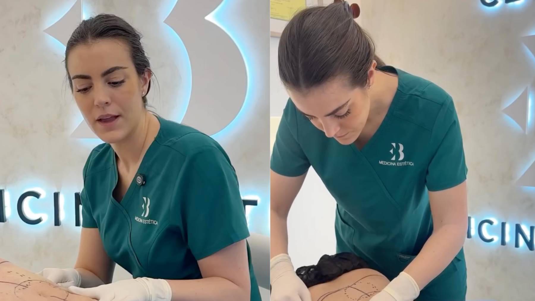 Todo sobre el lipoláser, la gran alternativa a la liposucción convencional: hablan los expertos