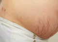 red stretch marks