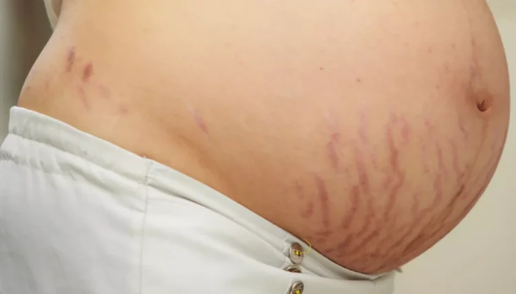 red stretch marks