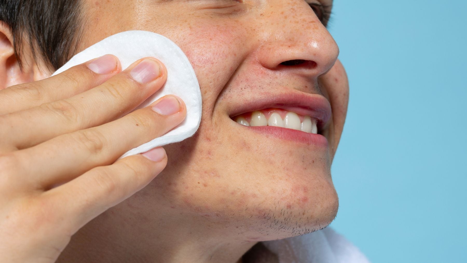 Patch, acne, science