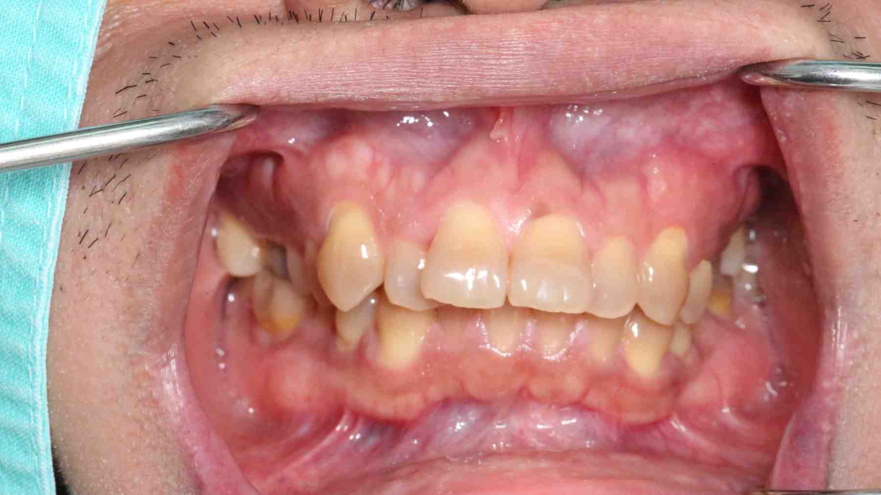 Close-up image of teeth and gums showing tartar buildup, plaque, and gum irritation during a dental exam