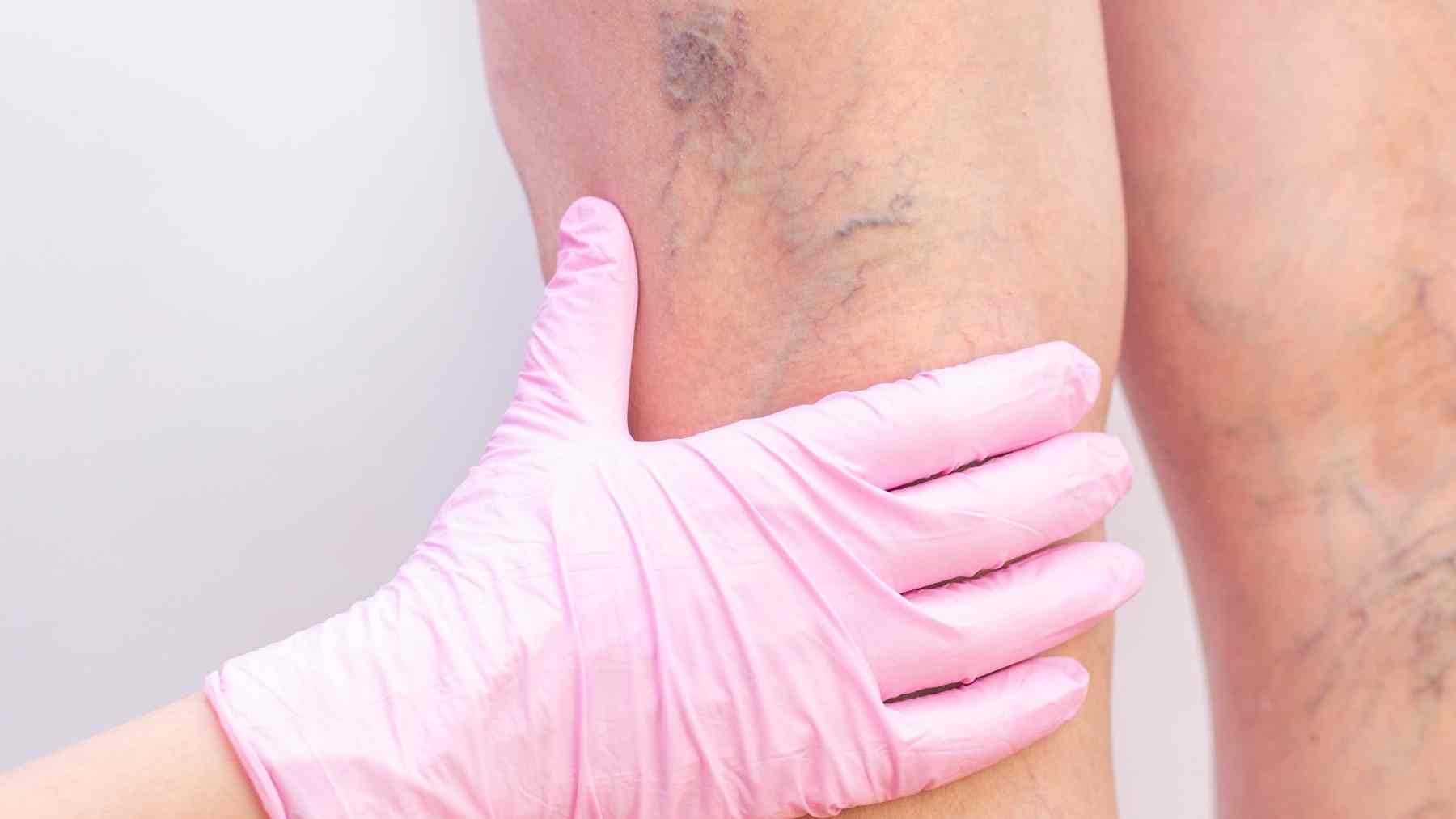 Doctor examining varicose veins on a patient’s leg during a medical checkup