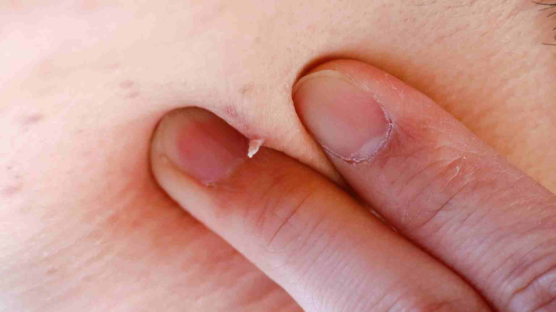 Close-up of a small wart on the neck being gently examined between two fingers