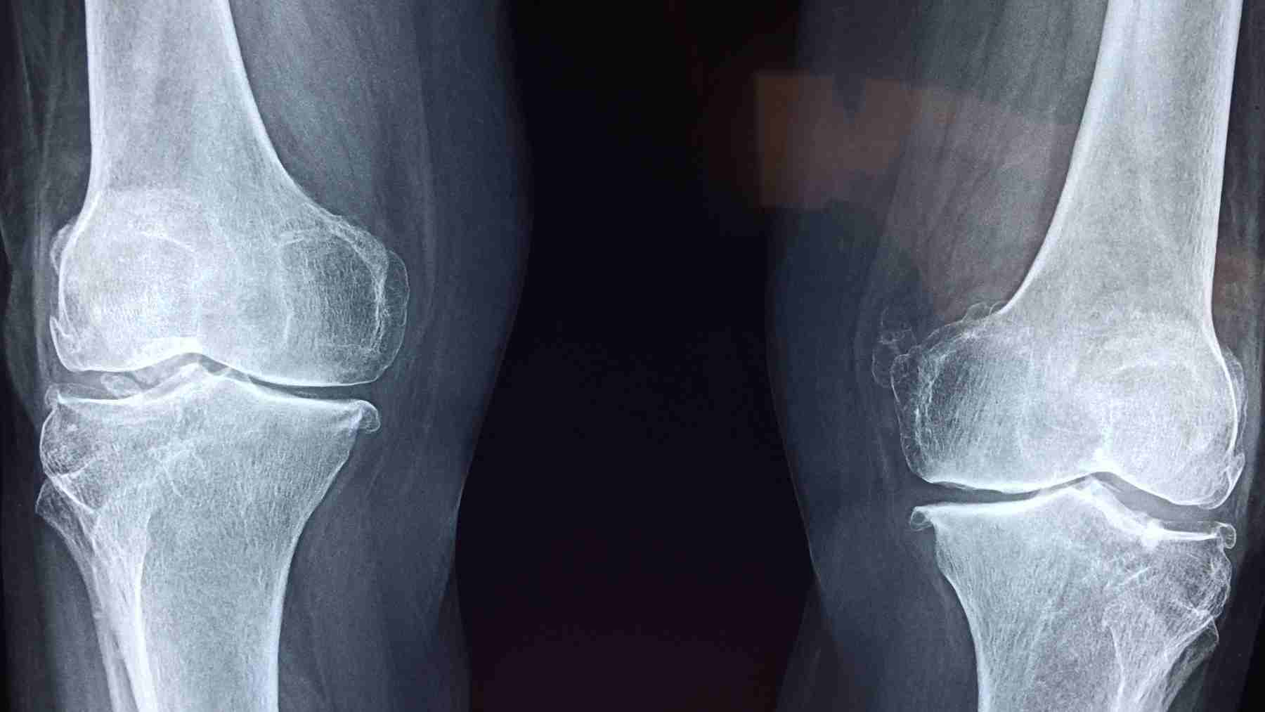 X-ray image of knee bones showing bone density structure related to osteoporosis research and mechanical signaling