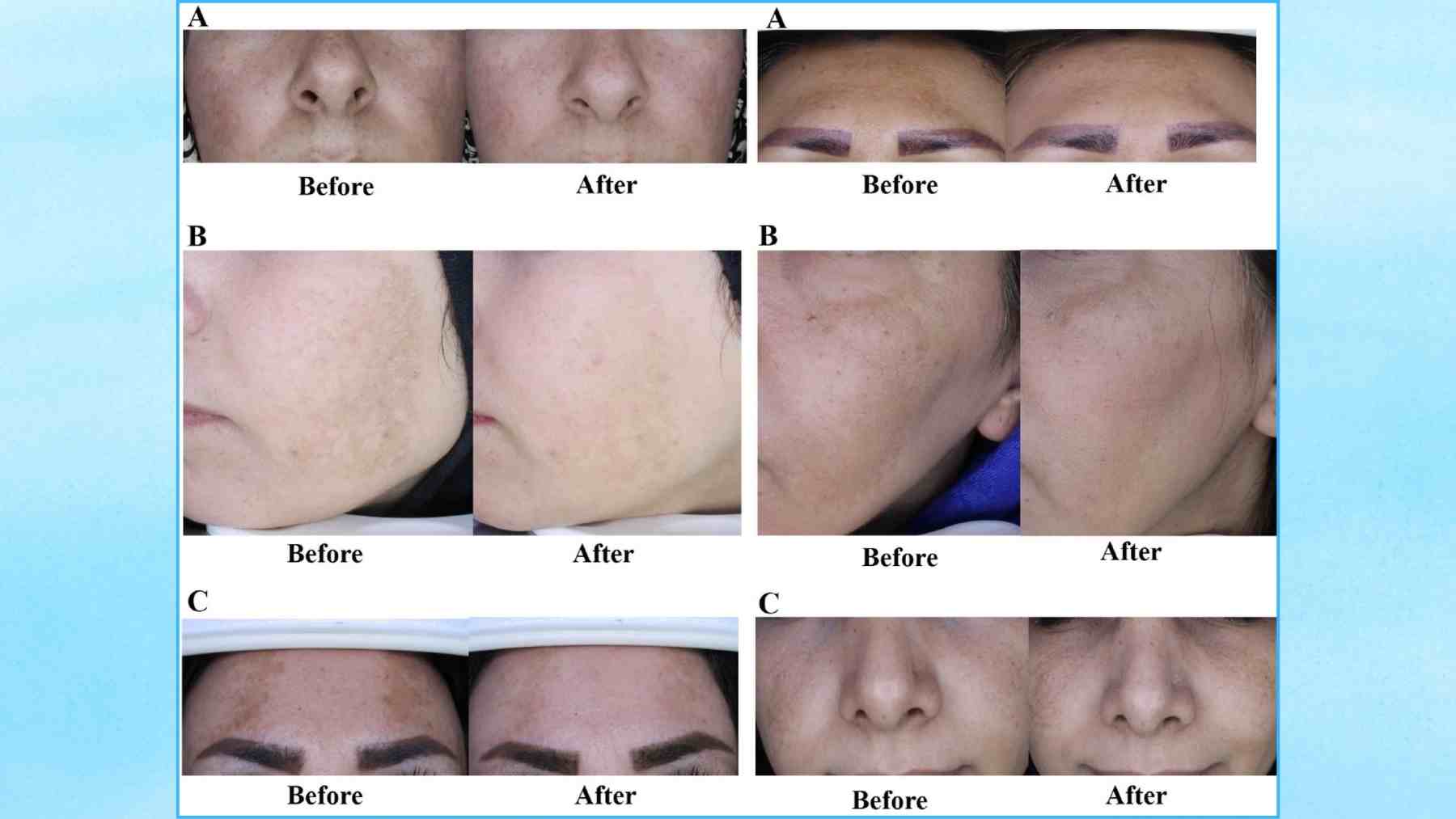 Before and after photos of melasma treatment comparing tranexamic acid and niacinamide creams with hydroquinone in 99 adults