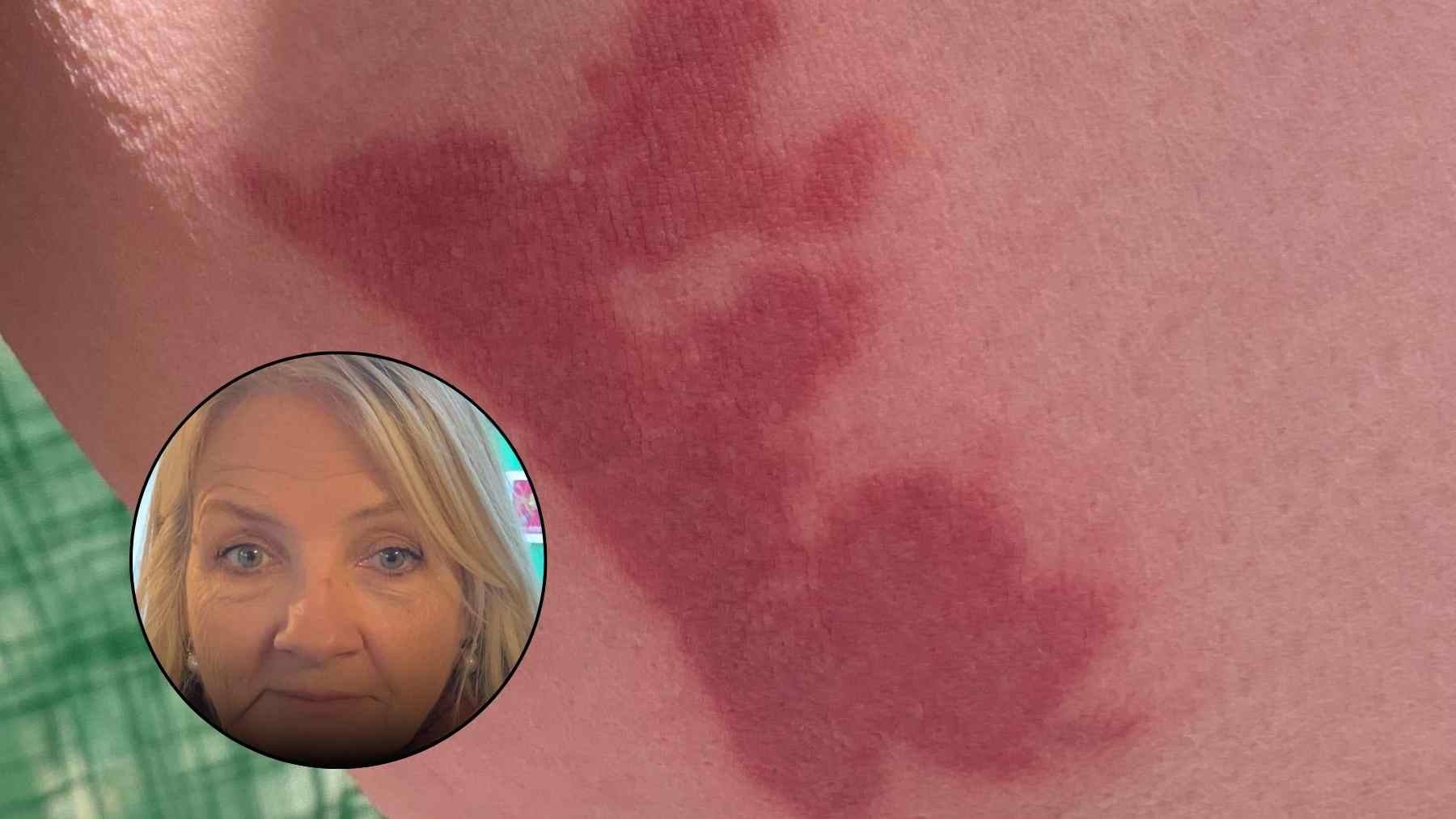 Serious red scald burn on a nurse’s thigh after hot coffee spilled during a Ryanair flight