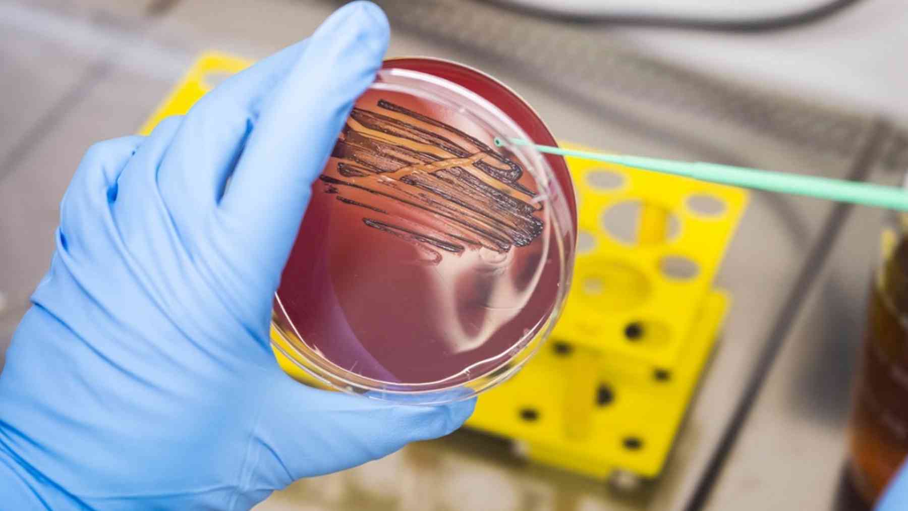 Scientist holds a petri dish with bacterial culture used in oral microbiome research for gum disease