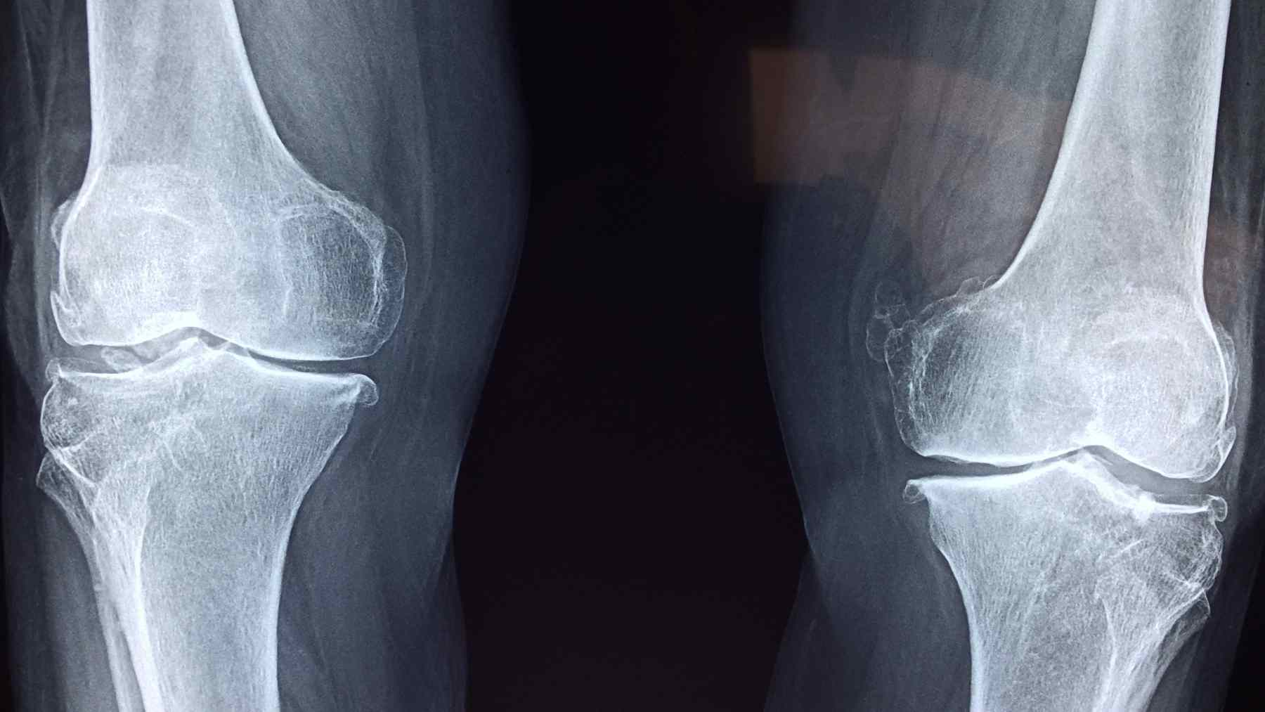 Knee X-ray showing joint wear, cartilage loss, and signs commonly linked to osteoarthritis