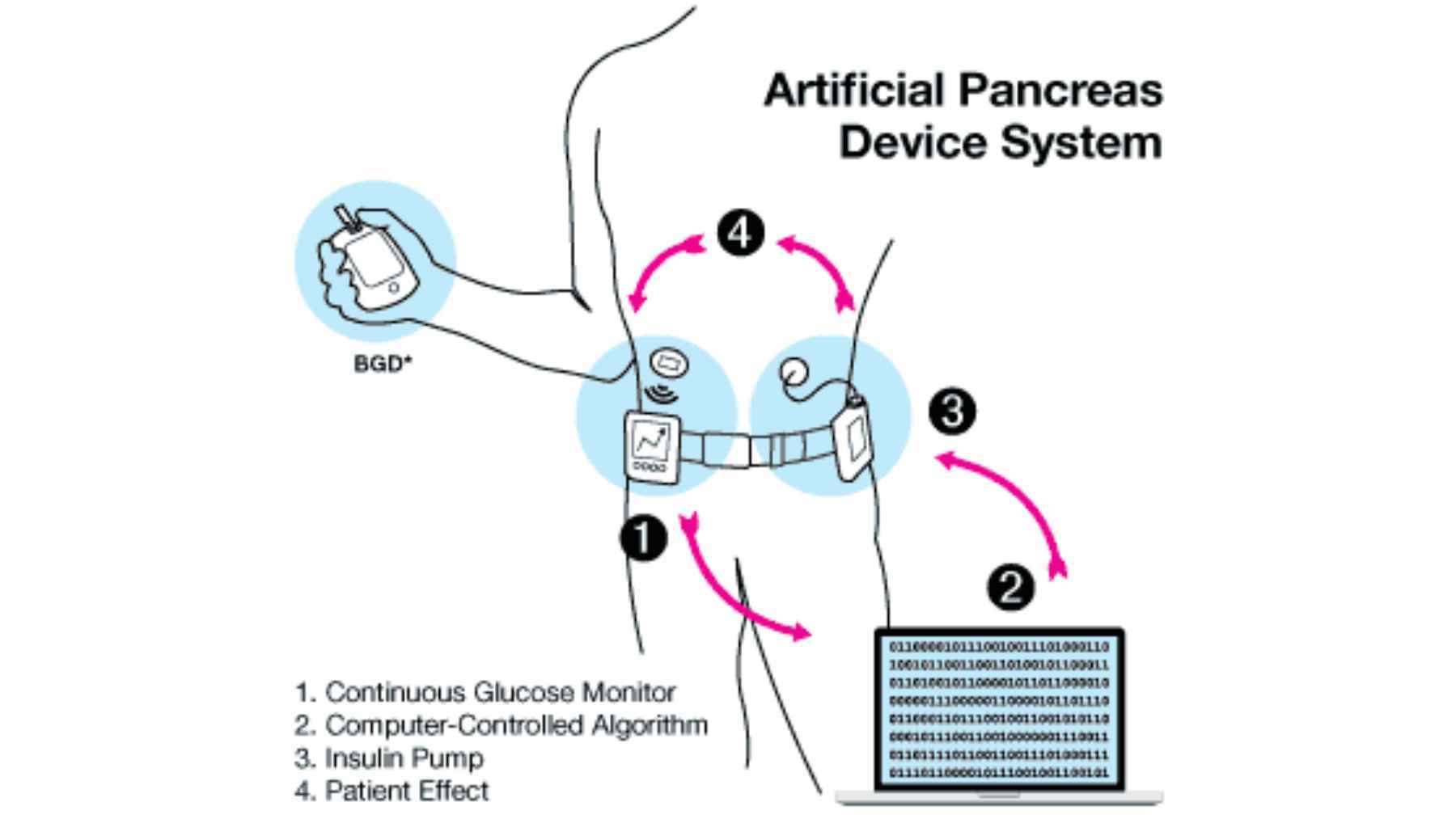 Scientists create an artificial pancreas with living cells, and some are already calling it a game changer for people with diabetes 1 Diagram of an artificial pancreas system showing continuous glucose monitoring, insulin delivery, and automated glucose control