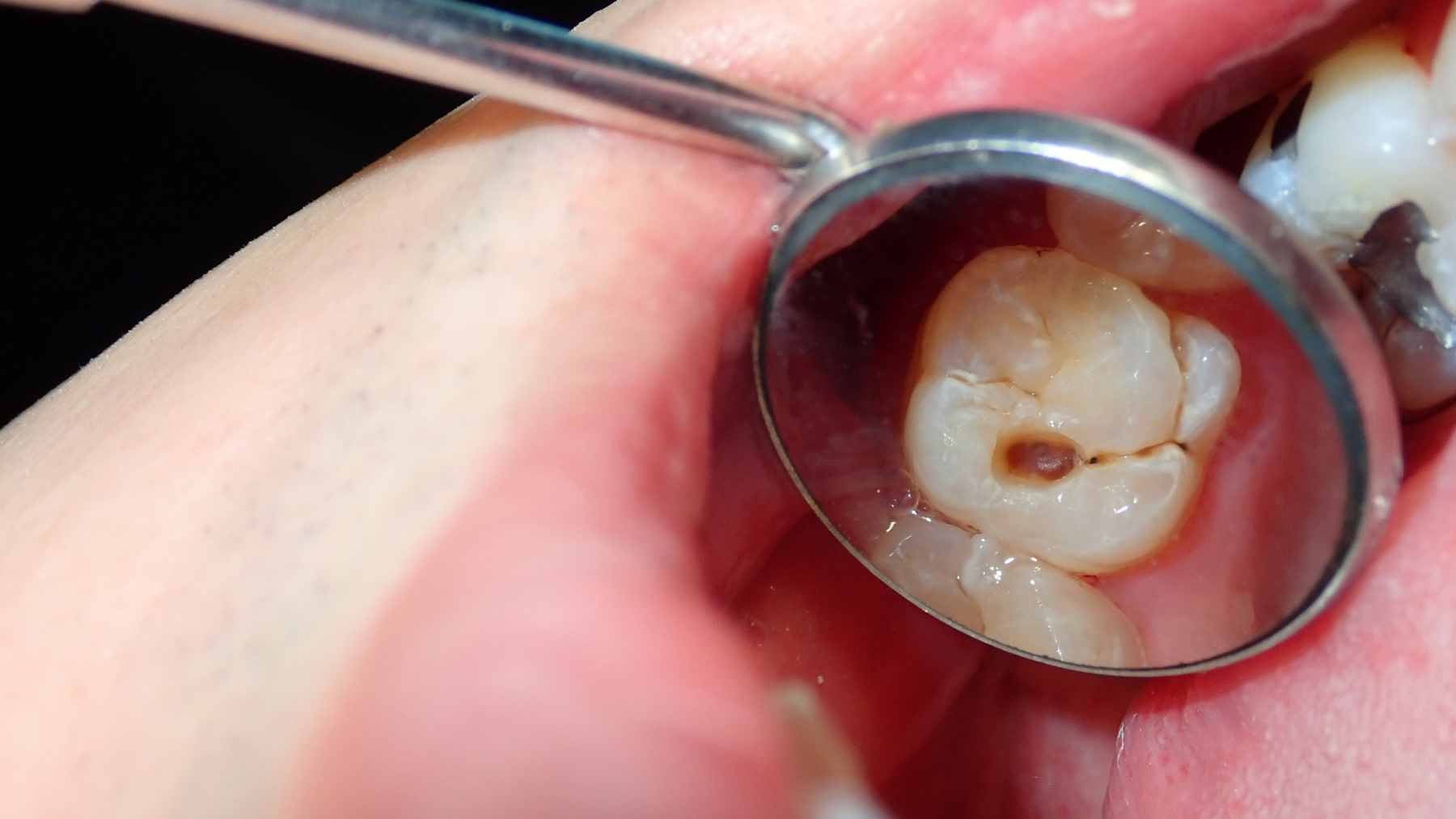 A dentist examining a patient's tooth with a probe and X-ray imaging visible on a monitor in the background.