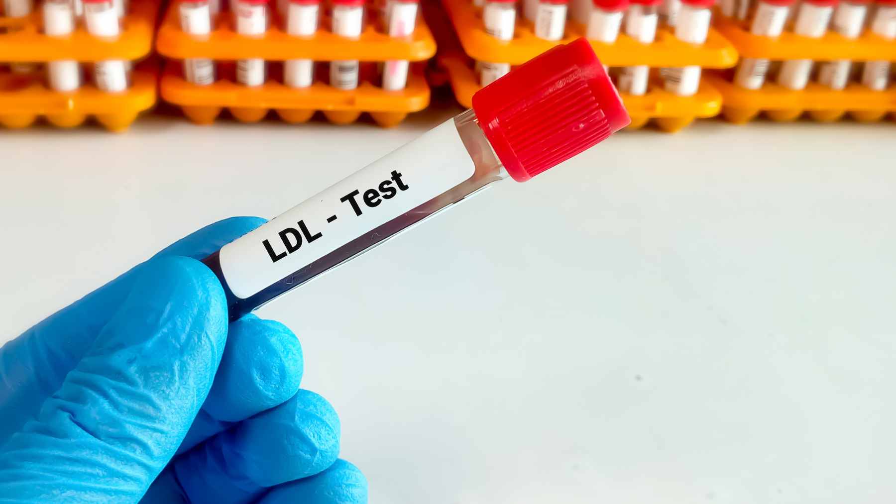 A medical illustration showing the accumulation of LDL cholesterol plaque within an artery wall over time.