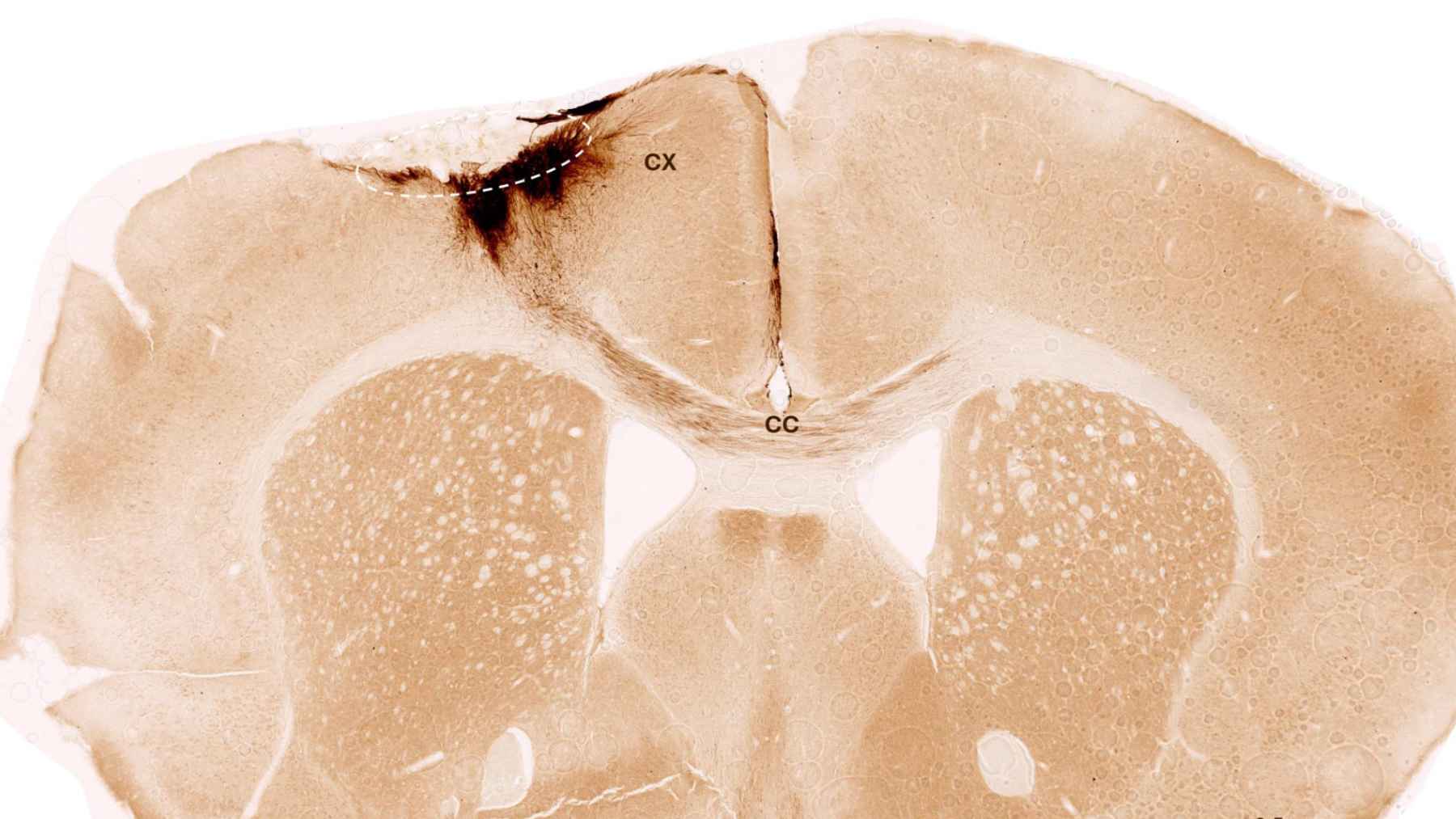 Scientists reversed stroke damage using stem cells in a breakthrough study, and recovery may be triggered even after the “window” people fear is closed 1 Microscopic image of a mouse brain showing stroke-damaged tissue and neural stem cell transplantation used in a regenerative medicine study.