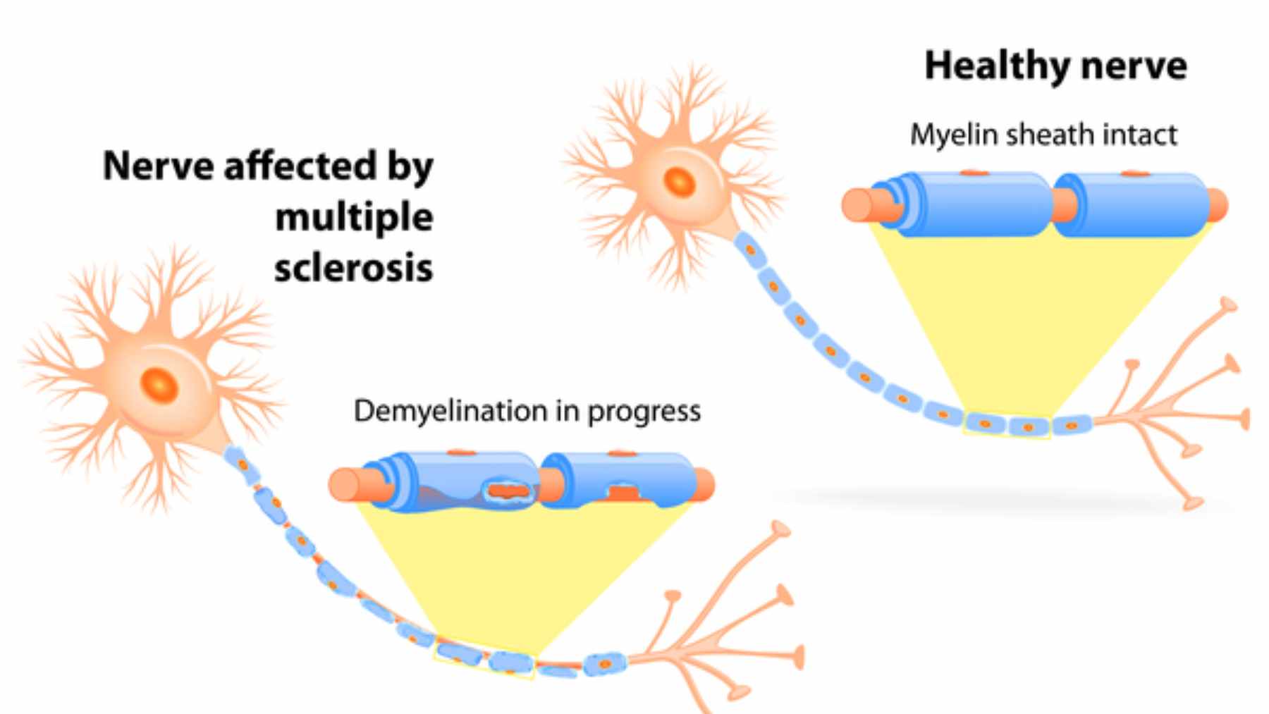 Scientists may have found a way to repair nerve damage in multiple sclerosis, with the approach targeting regeneration instead of only slowing attacks 1 A medical illustration comparing healthy nerve fibers with myelin to MS-damaged nerve fibers where the myelin coating has deteriorated.