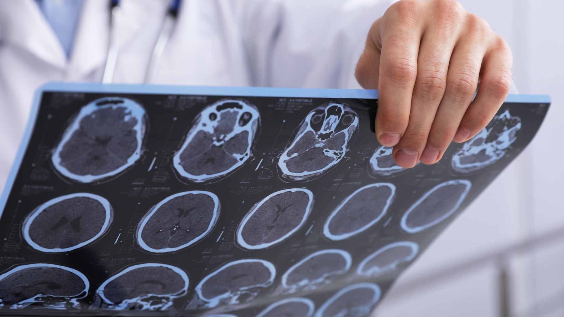 A medical illustration comparing healthy nerve fibers with myelin to MS-damaged nerve fibers where the myelin coating has deteriorated.