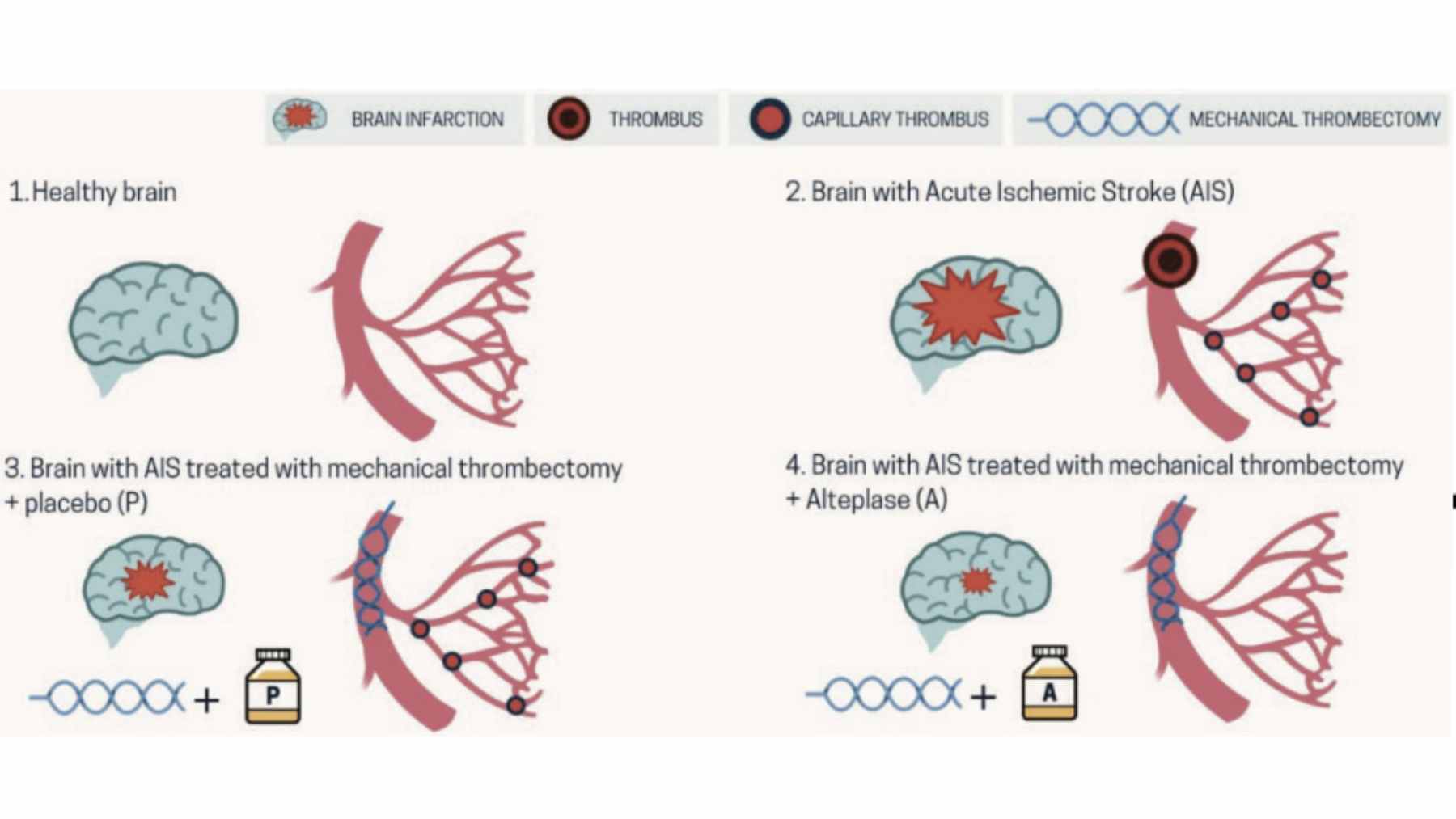 A Barcelona hospital study found a drug after thrombectomy improves recovery from severe stroke, indicating how a post-procedure step can change the outcome curve 1 A medical illustration showing a catheter performing a mechanical thrombectomy to remove a clot from a brain artery.